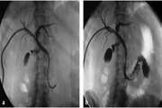 Nintinol Self-Expandable Metallic Stenting In Management Of Malignant Obstructive Jaundice: A Case Series 